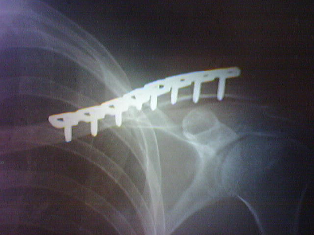 Andy Sapp - Metal Clavicle