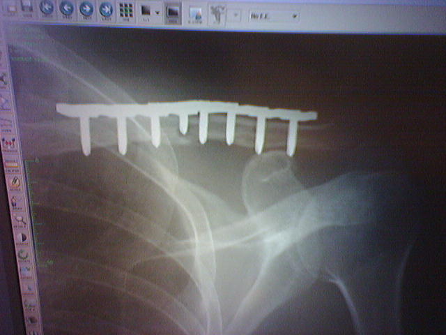 Andy Sapp - Metal Clavicle